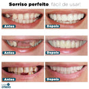 Facetas Dentárias Removíveis